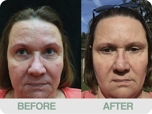 Treatments: AcquaGold, Microchanneling