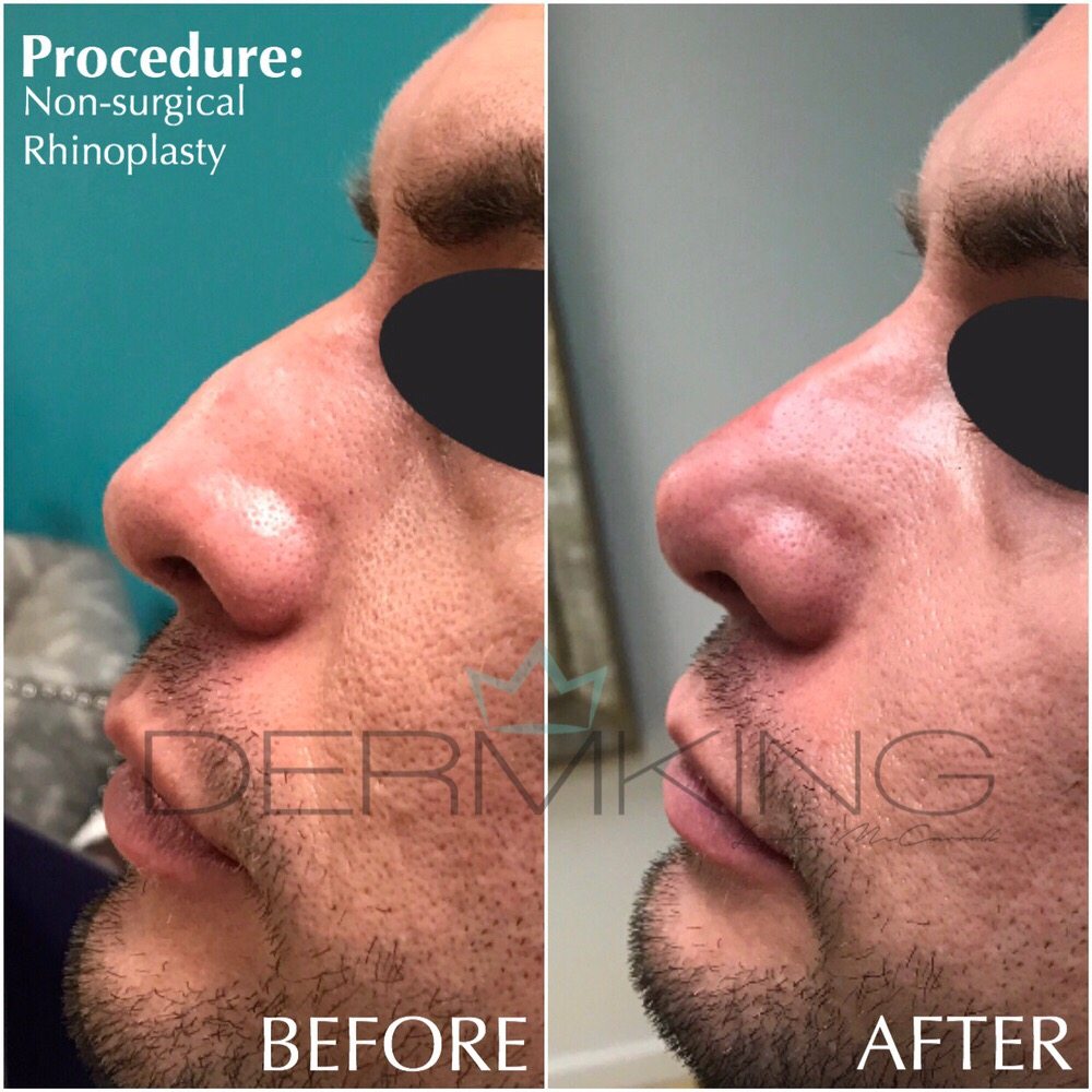 non surgical rhino